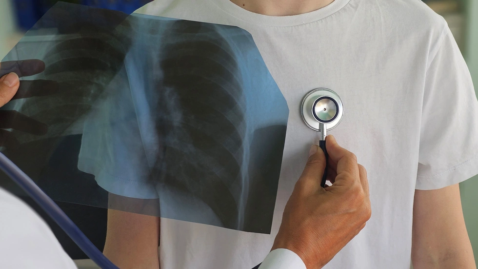 Tuberkulose wird beim Röntgen der Lunge erkannt Tuberkulose wird beim Röntgen der Lunge erkannt